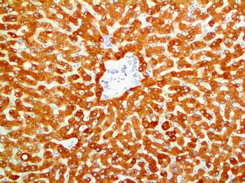 IHC of COX-2 on an FFPE Adenocarcinoma Tissue
